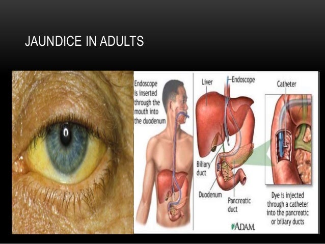 adult hyperbilirubinemia adult hyperbilirubinemia